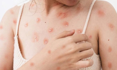 Cảnh báo thủy đậu ở người lớn có thể gây biến chứng nguy hiểm
