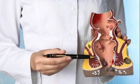 Trĩ nội độ 2 có cần mổ không?