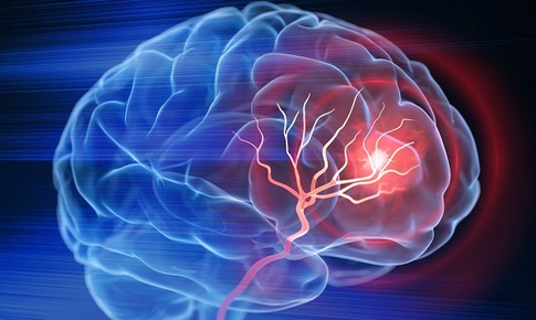 Áp lực, cường độ làm việc cao kéo dài có làm tăng nguy cơ đột quỵ ở người trẻ?
