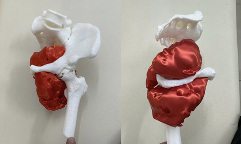 Cứu sống bệnh nhân ung thư hiếm gặp bằng phẫu thuật tháo nửa khung chậu