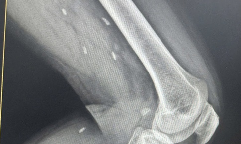 
Phát hiện nhiều kén sán ở chân bệnh nhân do một thói quen thường gặp