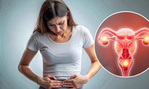 Đau bụng dưới cảnh giác với xoắn buồng trứng