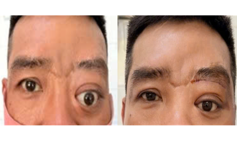 Bệnh hiếm gây lồi mắt, 20 năm Bệnh viện Tai Mũi Họng TPHCM chỉ gặp 2 ca