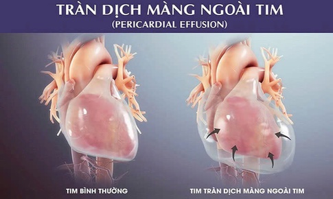 Cấp cứu bệnh nhi bị tràn dịch màng ngoài tim nguy kịch