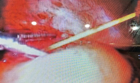 Nuốt tăm tre, người phụ nữ 35 tuổi bị áp xe ổ bụng phải mổ cấp cứu