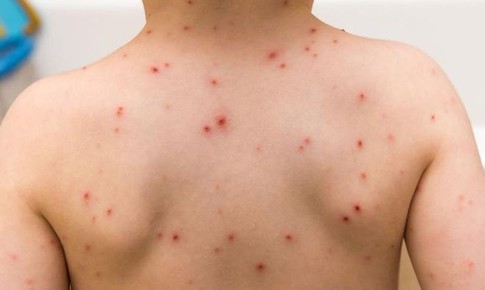 3 bệnh thường gặp ở trẻ vào mùa xuân