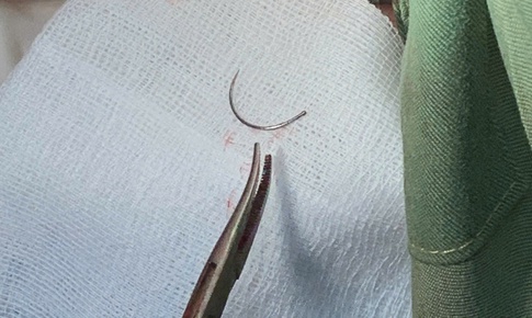 Kim khâu 'mắc kẹt' 11 năm ở tầng sinh môn của bệnh nhân