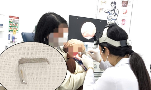 Ghim tất sắc nhọn mắc trong họng bé trai