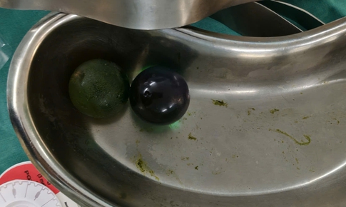 Nhiều trẻ nhỏ bị tắc ruột do nuốt hạt nở đồ chơi