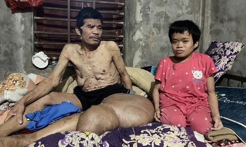 Người đàn ông có khối u khổng lồ đau xót nhìn vợ con lay lắt vì bệnh tật