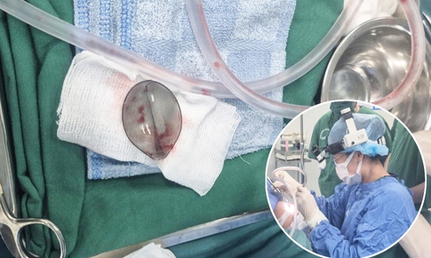 Kịp thời phẫu thuật lấy muỗng nhựa khỏi đường thở bé trai 4 tuổi