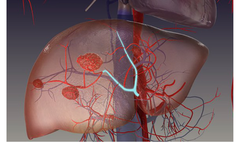 Đau tức hạ sườn, ăn kém, sút cân… cảnh giác với u máu gan