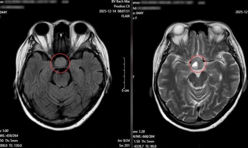 Nhìn mờ kéo dài, người phụ nữ phát hiện u tuyến yên nhờ khám mắt