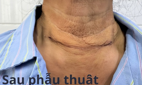 Phẫu thuật thành công bướu tuyến giáp khổng lồ thòng dưới xương đòn
