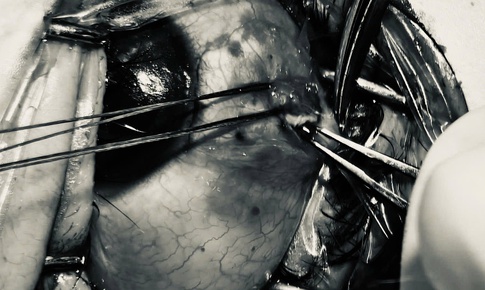 Bảo tồn nhãn cầu cho bệnh nhân bị đinh sắt bắn vào mắt