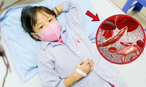 Giải mã nguyên nhân bố mẹ khỏe mạnh sinh con mắc bệnh tan máu bẩm sinh