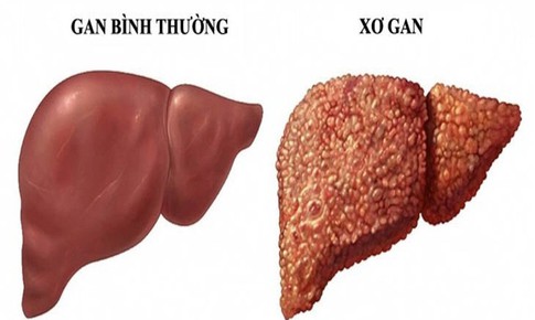 Dấu hiệu cảnh báo xơ gan không thể bỏ qua