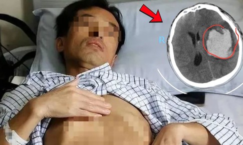 Người đàn ông đang khỏe mạnh bất ngờ đột quỵ, dấu hiệu nhiều người Việt bỏ qua