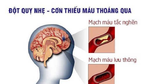5 dấu hiệu nhận biết sớm cơn thiếu máu não thoáng qua