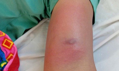 Giun rồng chui dưới da sau nhiều ngày đi rừng uống nước suối