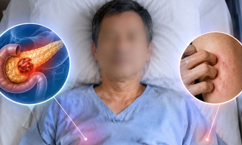 Tưởng dị ứng, người đàn ông 52 tuổi tử vong sau 6 tháng phát hiện ung thư