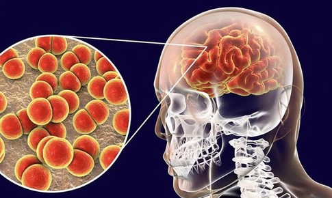 Sau chùm ca bệnh nhiễm não mô cầu tại trường học ở TP. HCM, Bộ Y tế khuyến cáo gì?