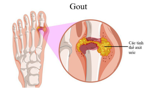Vì sao người trẻ có thể mắc gout?