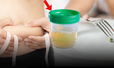 Nhịn ăn giảm cân, người phụ nữ 30 tuổi phát hiện tiểu đường, nước tiểu đầy bọt