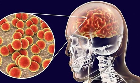 Bệnh não mô cầu nguy hiểm thế nào, phòng bệnh ra sao?