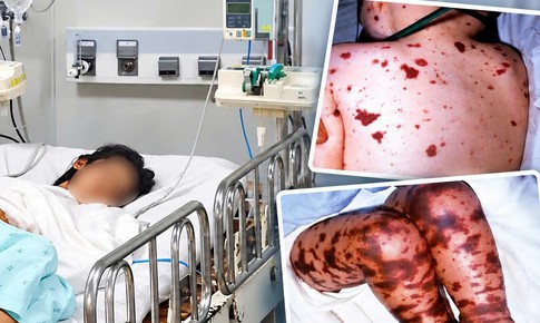 TPHCM ghi nhận ca não mô cầu mới tại xã Thường Tân