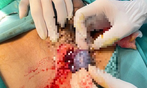 Nam giới đau vùng bẹn, cảnh giác dấu hiệu bệnh nguy hiểm