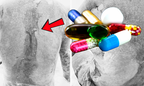 Dùng thuốc trị gout, người bệnh hoại tử da, nguy kịch tính mạng