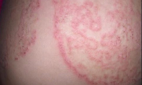 5 nguyên tắc quan trọng giúp phòng ngừa nấm da