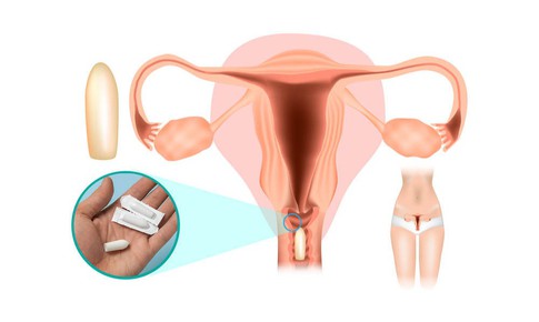 Vùng kín ngứa ngáy, đừng vội đặt thuốc nếu chưa biết điều này