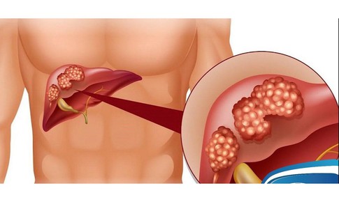 Gan nhiễm mỡ cấp độ mấy phải dùng thuốc kết hợp với ăn kiêng?