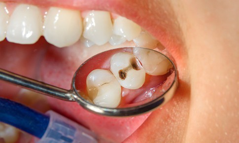 4 thói quen thường gặp có thể khiến răng sâu nhanh hơn