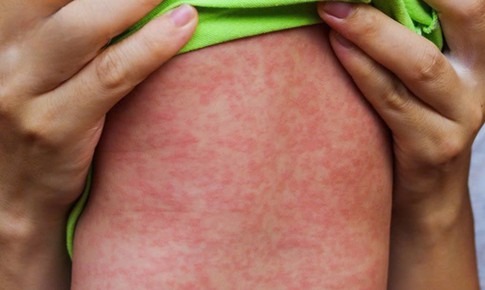 Mỹ: Bang New York ban bố tình trạng khẩn cấp do bệnh sởi