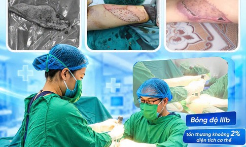 Ghép da cho bệnh nhân bỏng bô xe máy