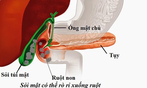 Sỏi túi mật khi nào cần mổ cấp cứu?