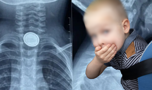 Bé 3 tuổi nuốt pin cúc áo, thực quản bị ăn mòn nghiêm trọng