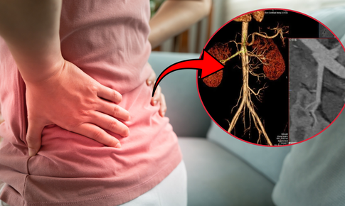 Đi khám vì đau hông lưng, phát hiện túi phình động mạch thận kích thước lớn