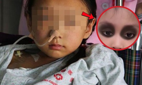 Mắt bé gái 4 tuổi chuyển màu tím vì ung thư, mẹ hối hận vì điều này