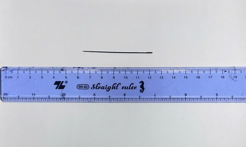 Lấy thành công kim khâu dài 6 cm nằm trong gan người đàn ông 