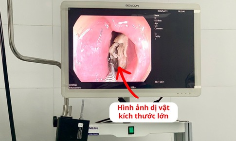 Lấy xương gà kích thước lớn mắc kẹt trong thực quản bệnh nhân