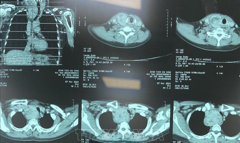 Chẩn đoán hình ảnh không cần phim in vào Quỹ BHYT chi trả
