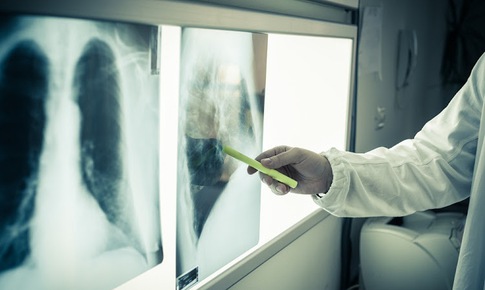 Bộ Y tế: Ưu tiên phân bổ ngân sách địa phương cho công tác phòng, chống lao