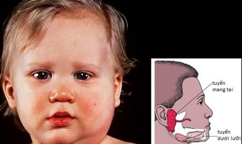 Bệnh quai bị bao lâu thì khỏi?