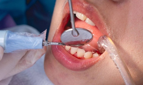 Những ai cần thận trọng khi lấy cao răng? 