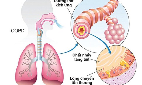 Phân biệt bệnh hen và COPD