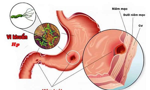 Tập luyện thể chất: Giải pháp không mất tiền phòng ngừa và hỗ trợ điều trị viêm loét dạ dày- tá tràng